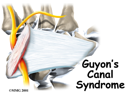 Guyon's Canal Syndrome