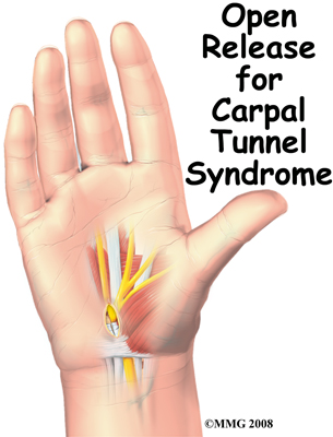 Open Carpal Tunnel Release
